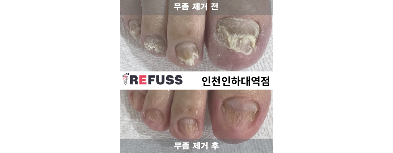 시흥시 내성발톱