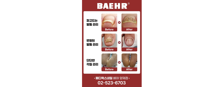 서울 강남구 내성발톱