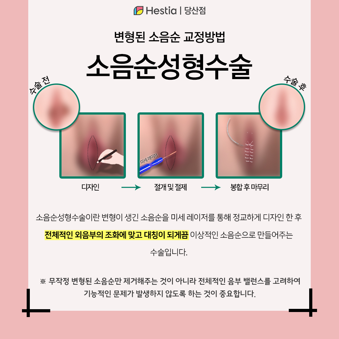 합정산부인과 소음순가려움 재발 확실한 치료방법은?