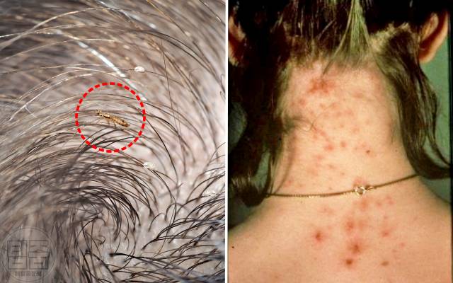 머릿니 물린자국 확인법,건강