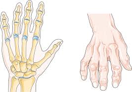 손가락 관절염 초기증상