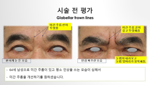 미간 주름 필러