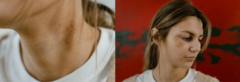 멍 빨리 없애는 방법 멍들었을 때 빨리 낫는 방법