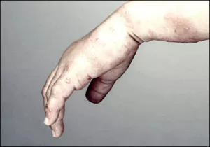 대상포진 초기증상