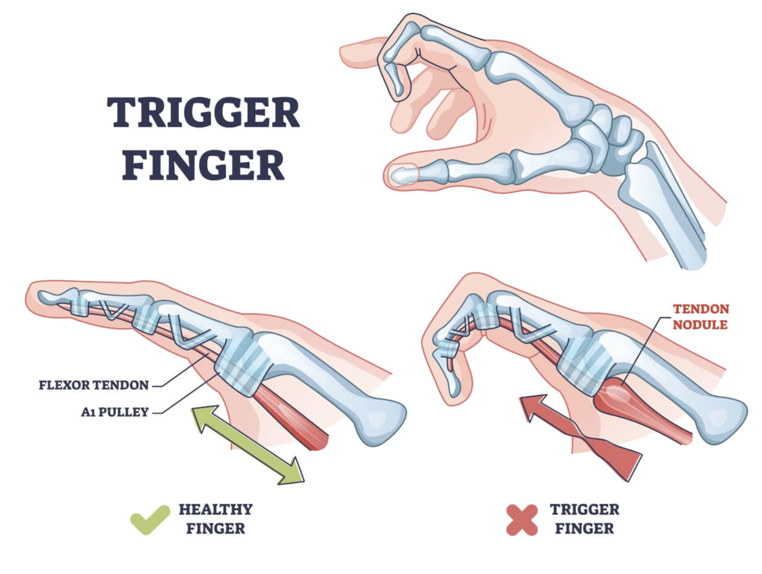 방아쇠수지-triggerfinger-손가락통증