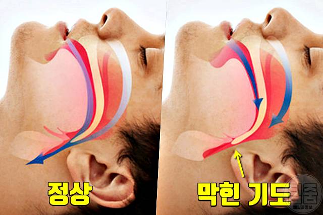 코골이 고치는법 수면부족 코골이방지 수술 치료