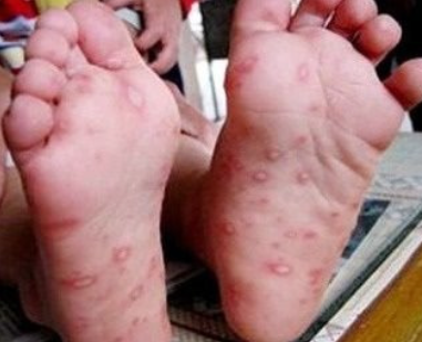 잠복기 동안 나타날 수 있는 초기 징후