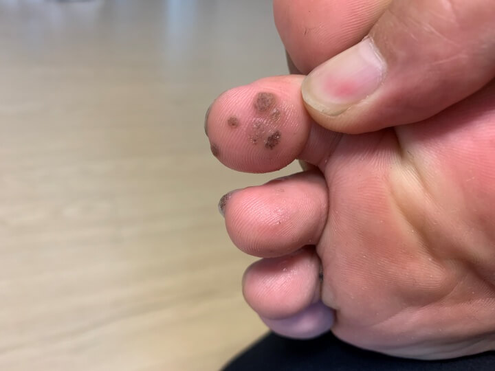 꾸준히-닥터딥-바른-족저-사마귀