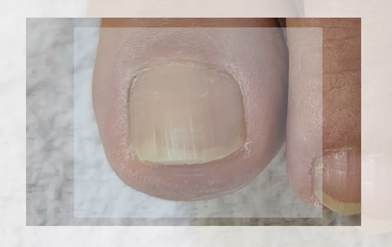 엄지발톱 노란색 변색