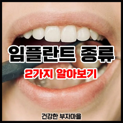 임플란트 종류