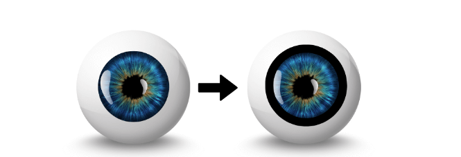 아이링수술, 아이링수술후기, 써클렌즈 대체, 눈동자확대수술, 미용성형, 안과 시술, 렌즈부작용