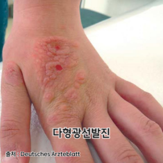 햇빛-알레르기-증상