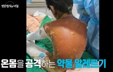 약물알레르기