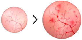 허너병변-Hunner-lesion