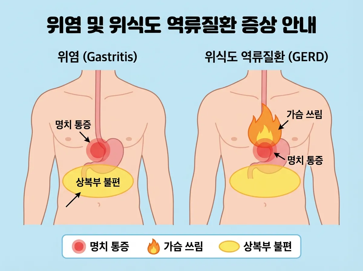 명치 통증, 가슴 쓰림, 상복부 불편감 위치를 표시한 인체 해부도 인포그래픽