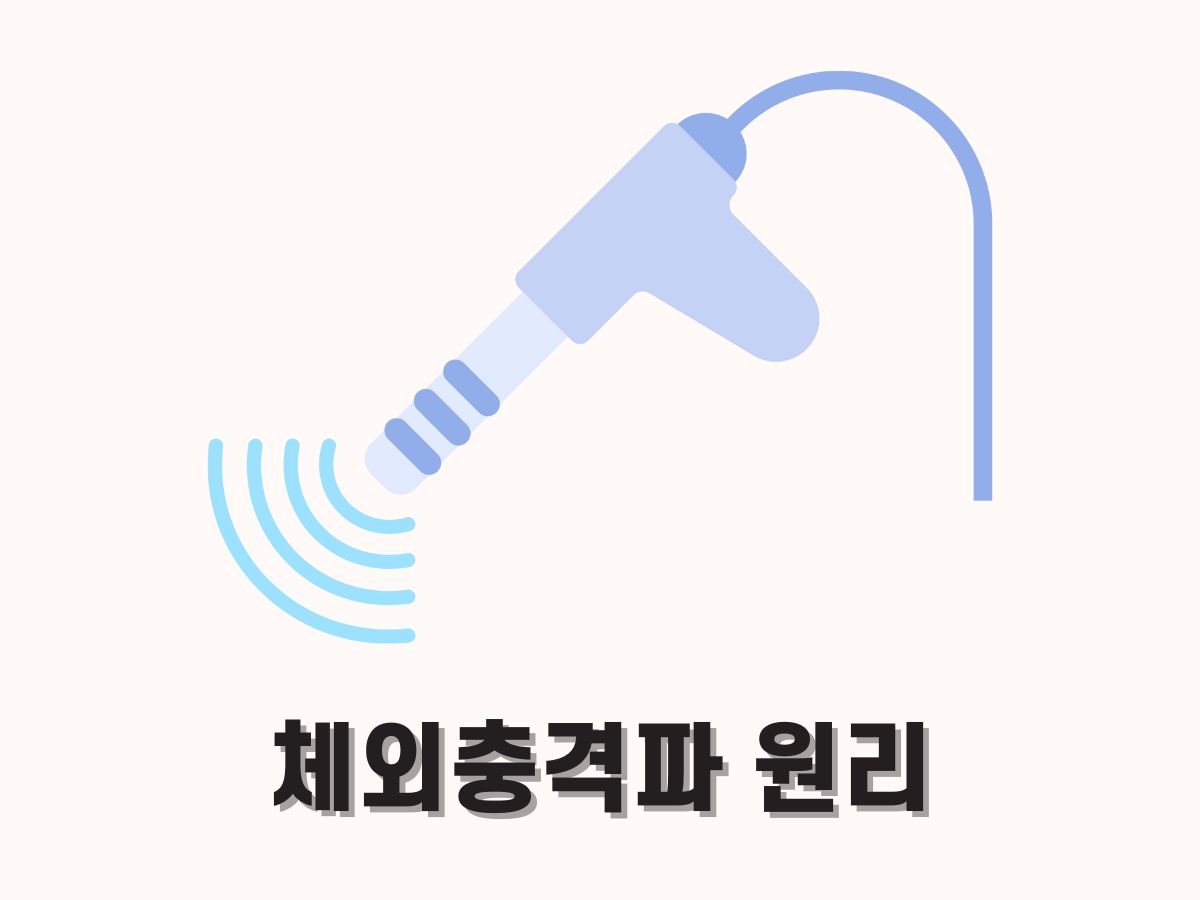 체외충격파 치료 원리