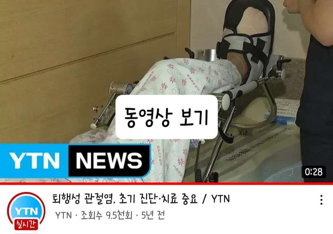 관절염 초기증상