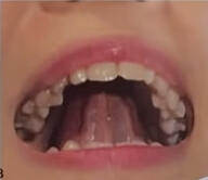 코골이예방운동1