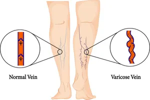 발목이-붓는-이유
