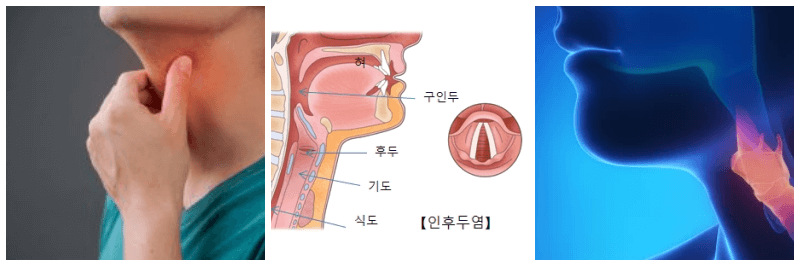 인후염 관련 사진 3개