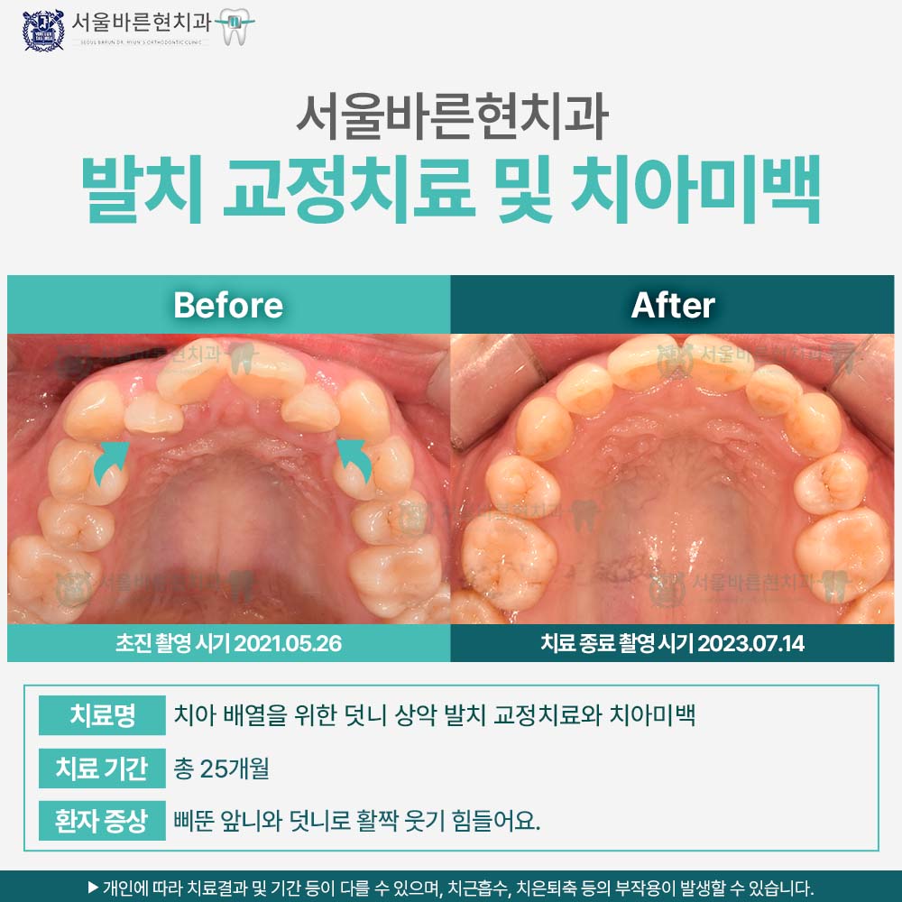 부산치아교정