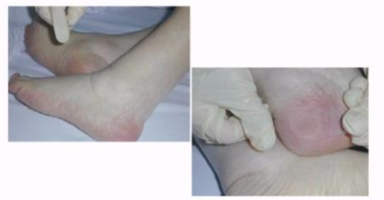 욕창이 잘 생기는 부위 TOP5와 원인