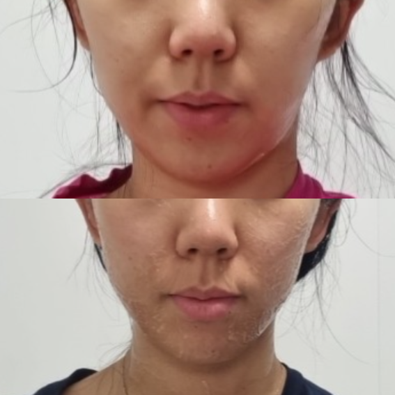 에이지알-내돈내산-전후사진