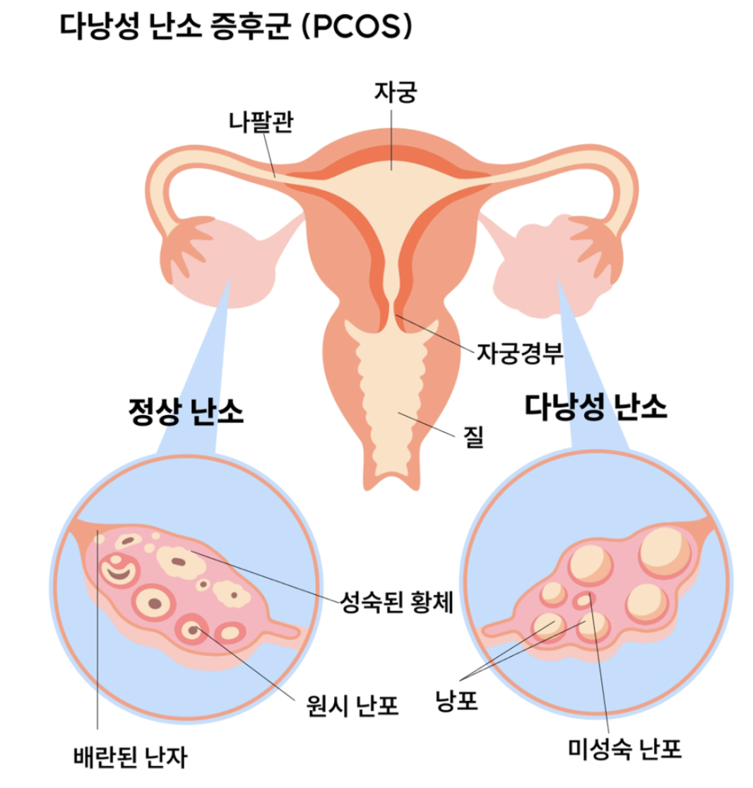 이노시톨 다낭성 난소 증후군