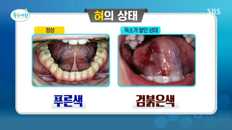 만성 염증 자가진단법