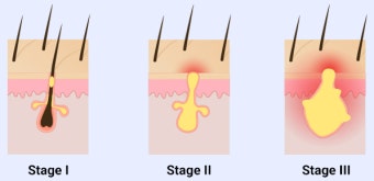 화농성 한선염 치료 수술 병원