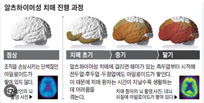알츠하아머성 치매 진행과정