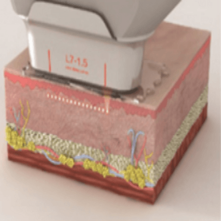 아이슈링크 원리