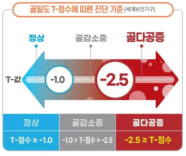 골다공증 진단기준