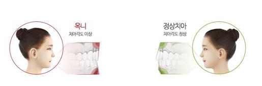 돌출입 교정 후 부작용, 옥니