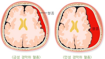 급성 경막하혈종
