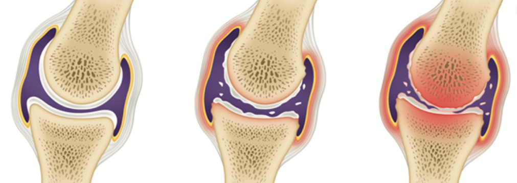 글루코사민 효능&amp;#44; 부작용&amp;#44; 복용법&amp;#44; 추천 상품