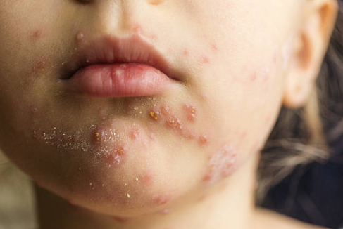 대상포진 증상&amp;#44; 전염&amp;#44; 치료방법 총정리 (2024ver)