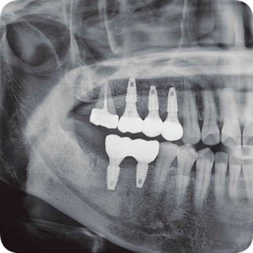 임플란트 보험 임플란트 가격 임플란트 비용 치아 보험 추천 치과 보험 추천 임플란트 치아 보험 치아 보험 적용 기과 보험 적용 치과 보험 임플란트 임플란트 치아