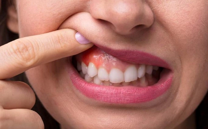 치은염 증상 8가지