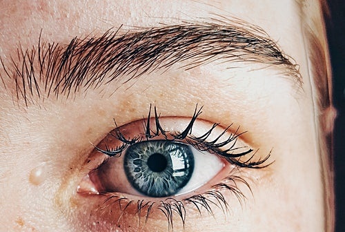 비염증성 여드름