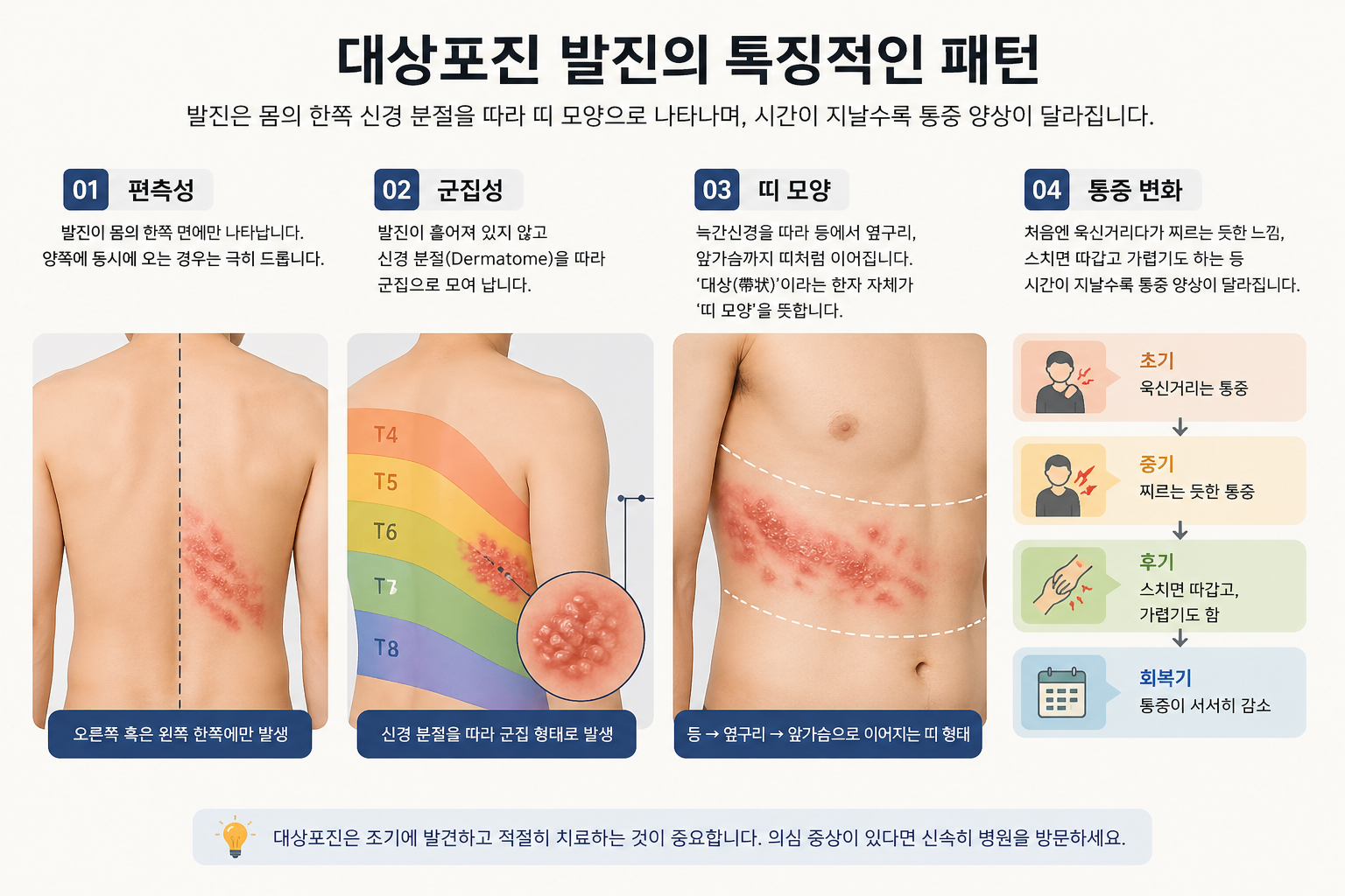 대상포진 (초기증상, 자가진단, 신경통)