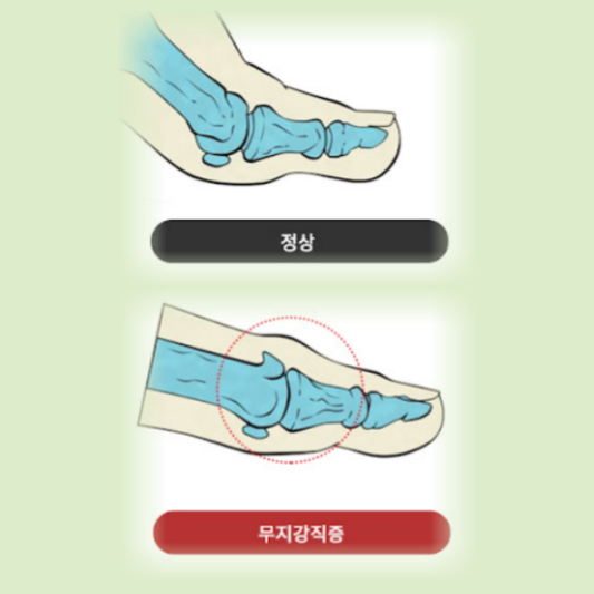 무지강직증, 이렇게 치료하면 엄지발가락 통증 완화 가능!