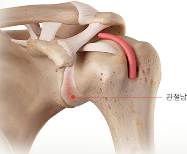 오십견 증상 9가지 총정리 섬네일