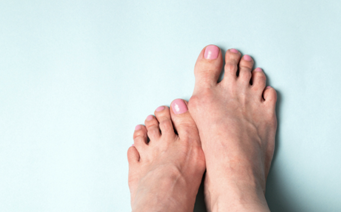 무지외반증-수술비용