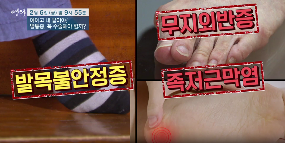 명의 발통증 족저근막염