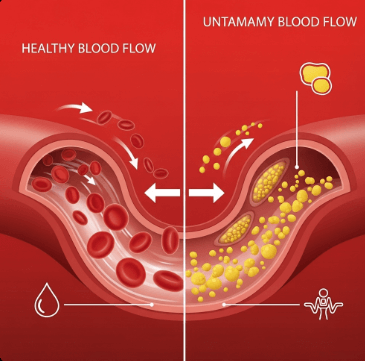 고지혈증 증상과 원인3