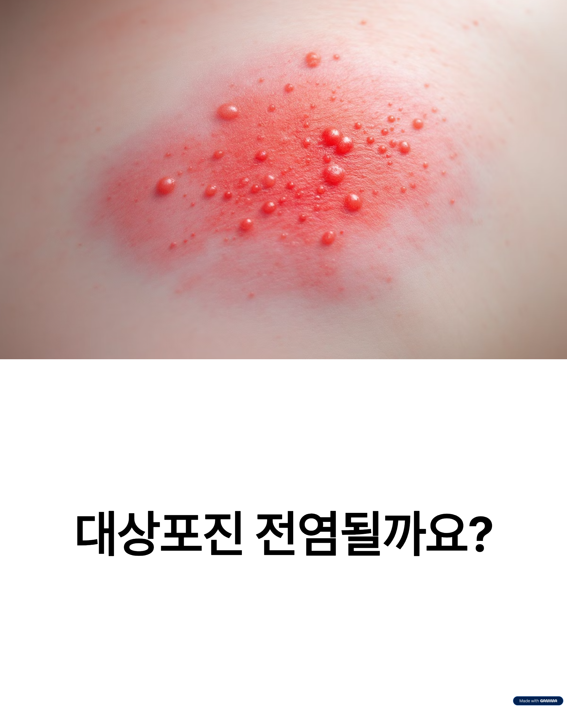 대상포진 전염 되나 치료방법 반드시 알아야 할 핵심 정리