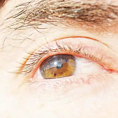 알레르기결막염