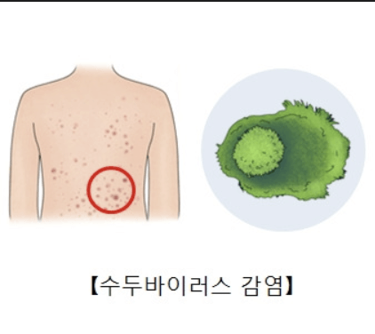 수두 바이러스 감염