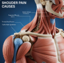 어깨통증 원인